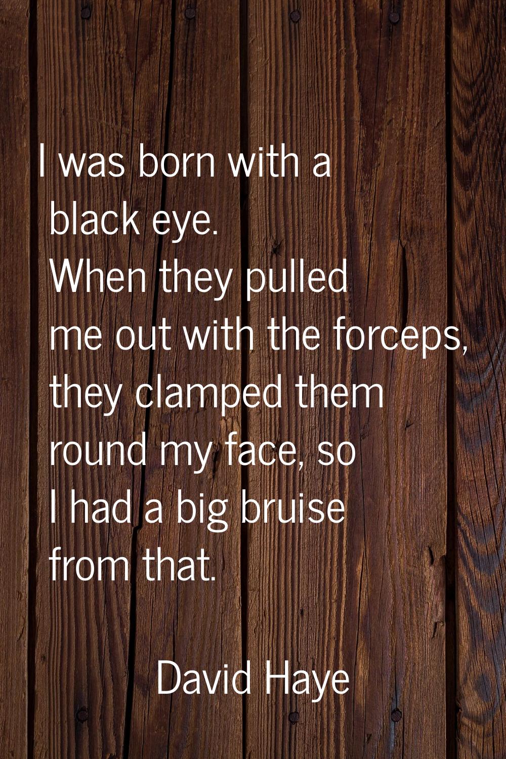 I was born with a black eye. When they pulled me out with the forceps, they clamped them round my f