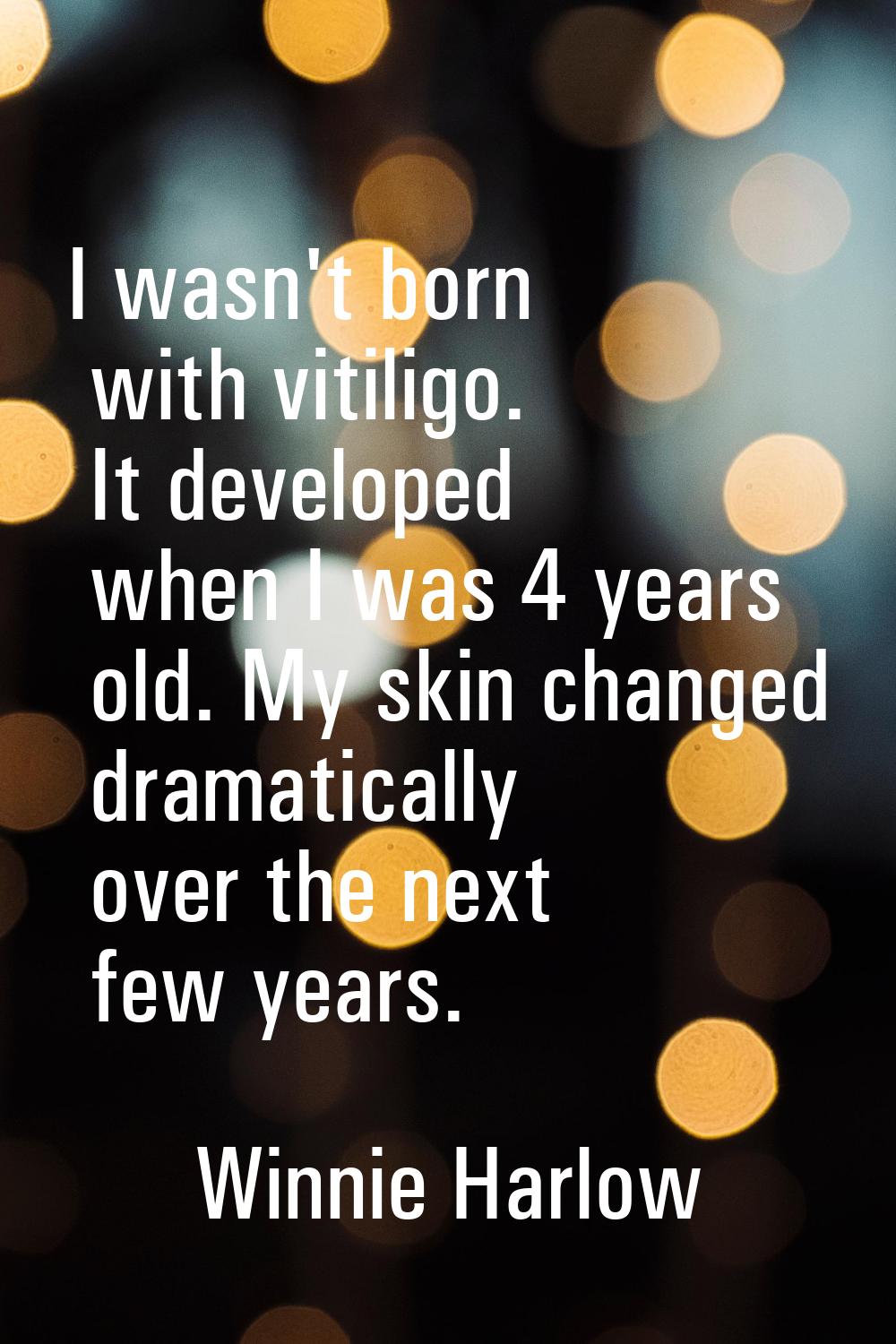 I wasn't born with vitiligo. It developed when I was 4 years old. My skin changed dramatically over